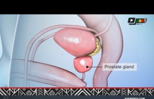 Prostate à Bamako : Briser le silence pour mieux soigner.